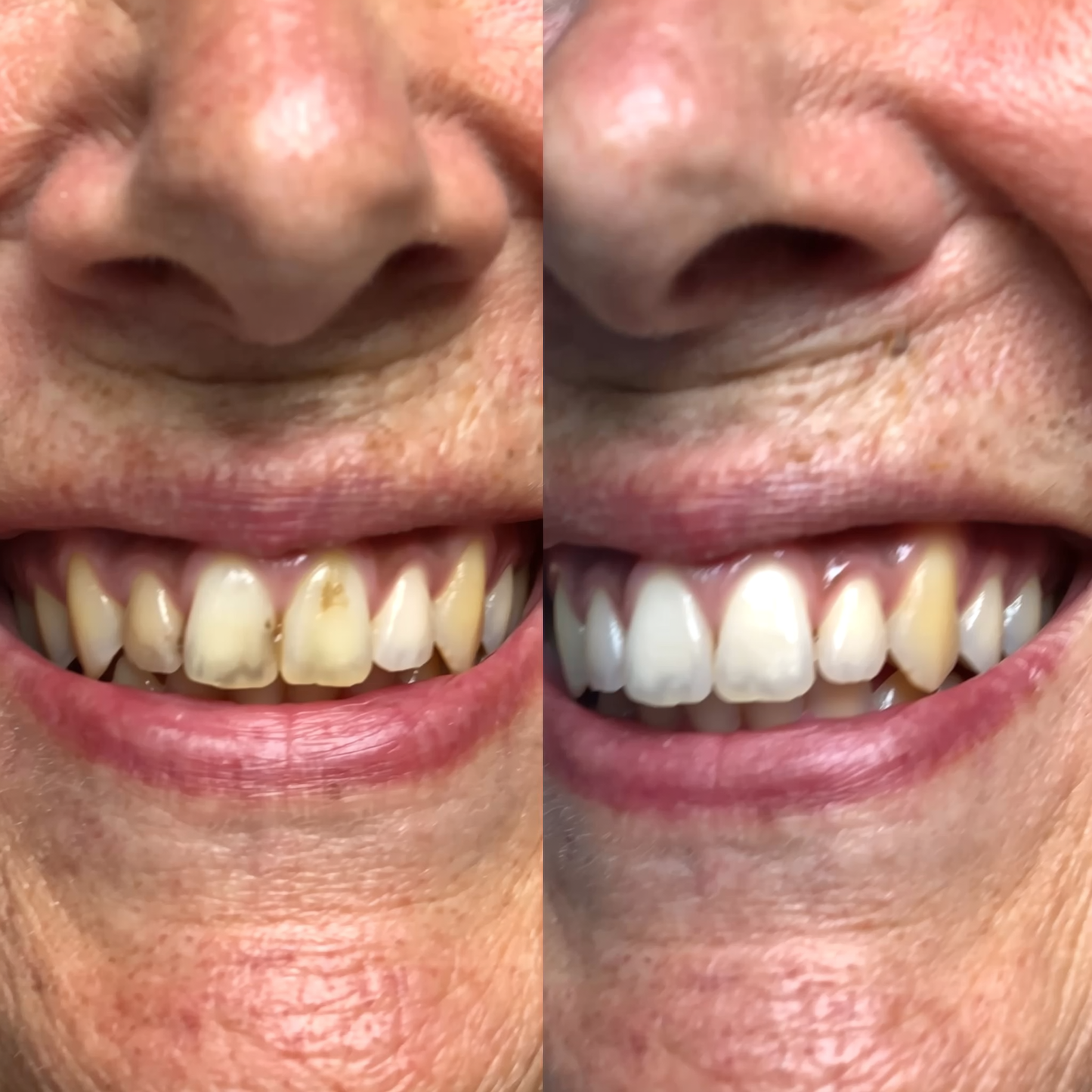 Poudre de Blanchiment Dentaire - 5D White