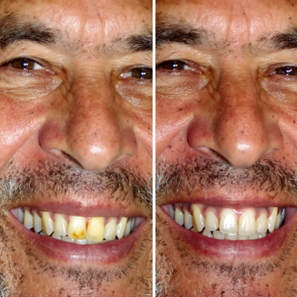 Poudre de Blanchiment Dentaire - 5D White